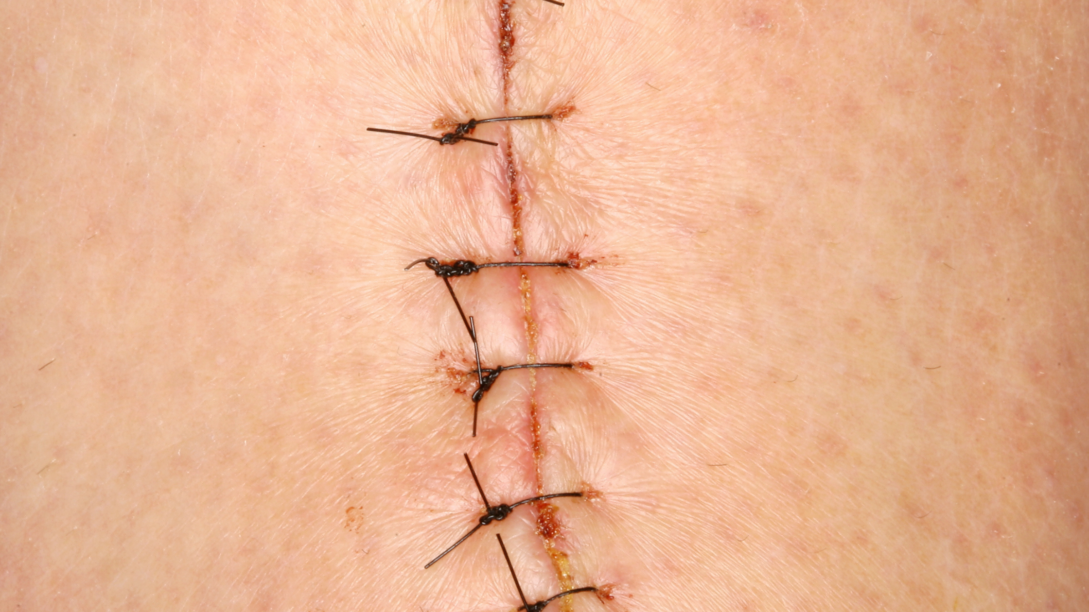 Can You Use a Sauna with Stitches